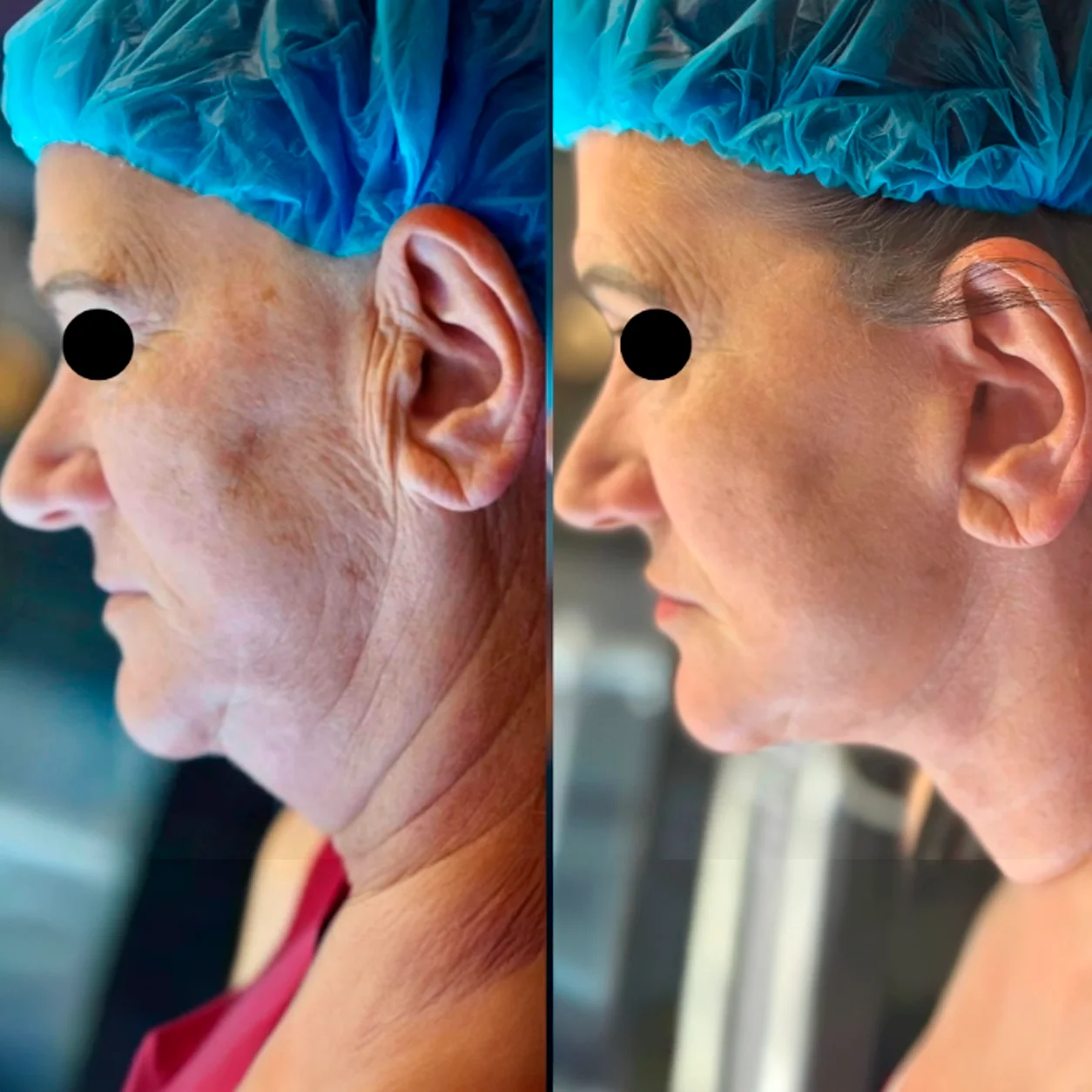 Resultado de lipoplastia facial